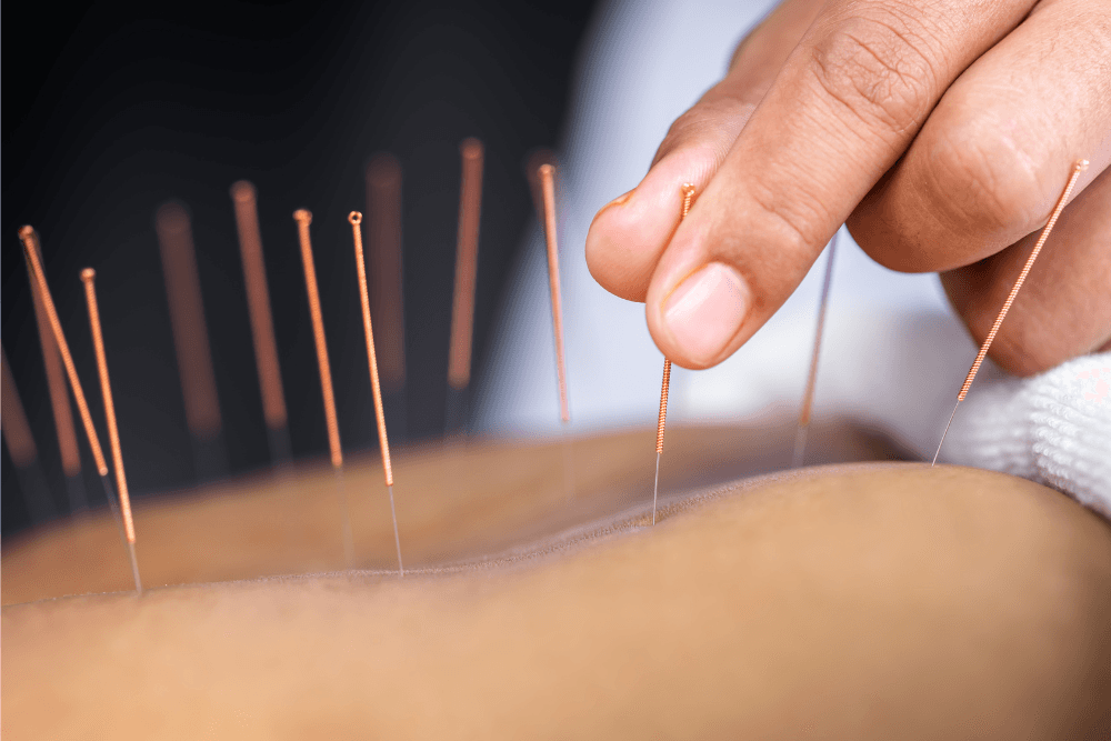 Acupuncture Open Morning